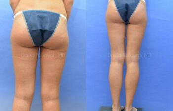 Liposuction Before and After | Sayah Institute