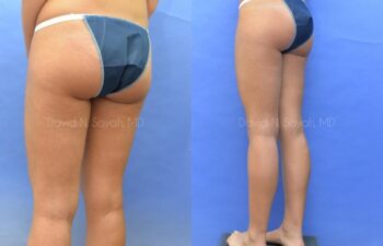 Liposuction Before and After | Sayah Institute