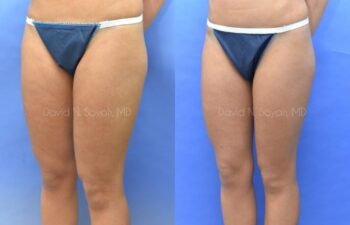 Liposuction Before and After | Sayah Institute