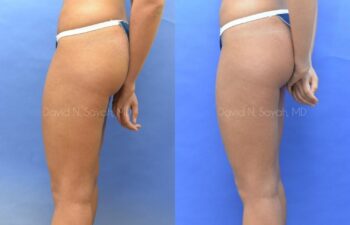 Liposuction Before and After | Sayah Institute
