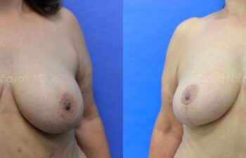 Breast Reduction Before and After | Sayah Institute