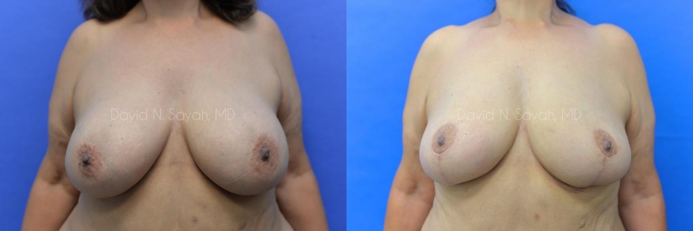 Breast Reduction Before and After | Sayah Institute