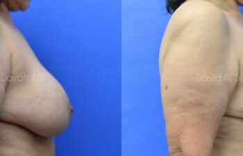 Breast Reduction Before and After | Sayah Institute