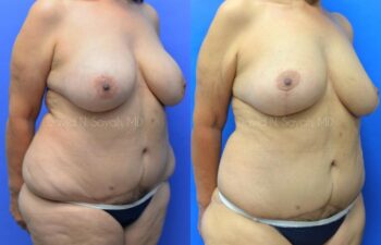 Breast Reduction Before and After | Sayah Institute