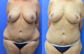 Breast Reduction Before and After | Sayah Institute