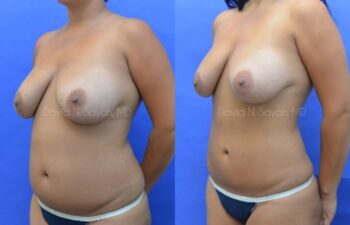 Liposuction Before and After | Sayah Institute