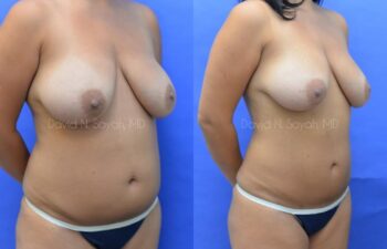 Liposuction Before and After | Sayah Institute