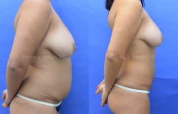 Liposuction Before and After | Sayah Institute