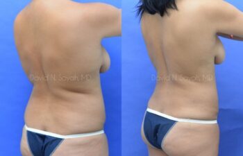 Liposuction Before and After | Sayah Institute