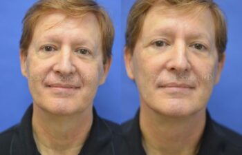 Facelift Before and After | Sayah Institute