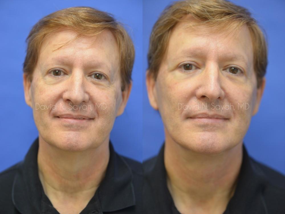 Facelift Before and After | Sayah Institute