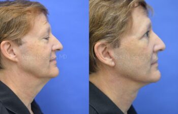 Facelift Before and After | Sayah Institute