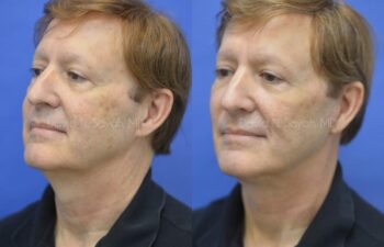 Facelift Before and After | Sayah Institute
