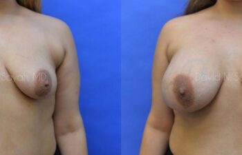 Breast Augmentation Before and After | Sayah Institute
