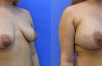Breast Augmentation Before and After | Sayah Institute