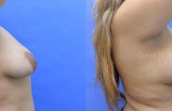 Breast Augmentation Before and After | Sayah Institute