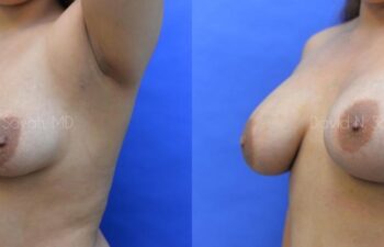 Breast Augmentation Before and After | Sayah Institute