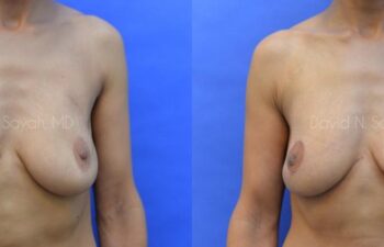 Breast Reconstruction Before and After | Sayah Institute