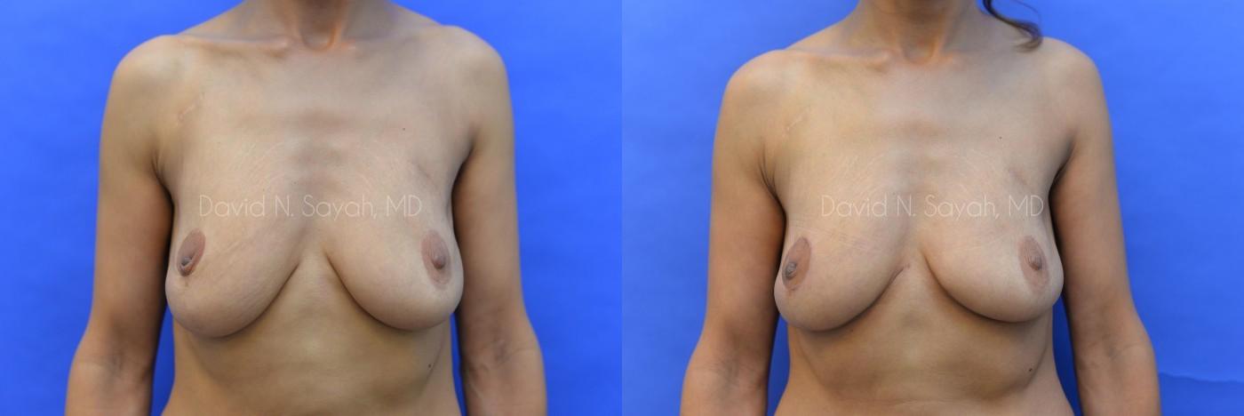 Breast Reconstruction Before and After | Sayah Institute