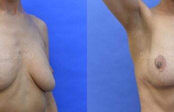 Breast Reconstruction Before and After | Sayah Institute