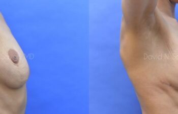 Breast Reconstruction Before and After | Sayah Institute