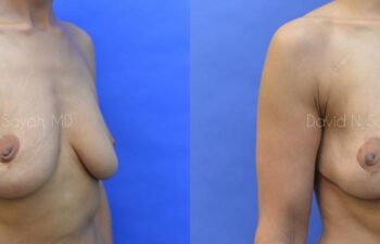 Breast Reconstruction Before and After | Sayah Institute