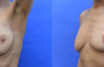 Breast Reconstruction Before and After | Sayah Institute