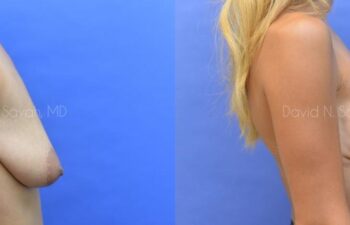 Breast Augmentation Before and After | Sayah Institute