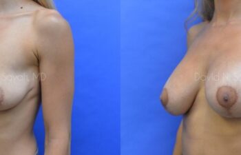 Breast Augmentation Before and After | Sayah Institute