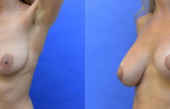 Breast Augmentation Before and After | Sayah Institute