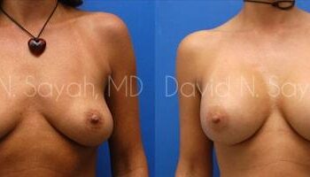 Breast Augmentation Before and After | Sayah Institute