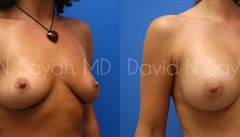 Breast Augmentation Before and After | Sayah Institute