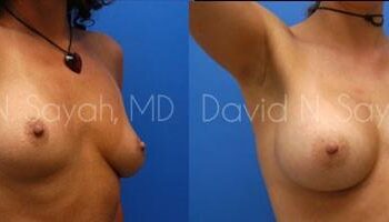 Breast Augmentation Before and After | Sayah Institute