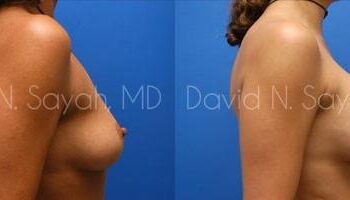 Breast Augmentation Before and After | Sayah Institute
