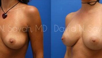 Breast Augmentation Before and After | Sayah Institute