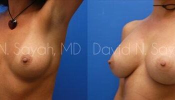 Breast Augmentation Before and After | Sayah Institute