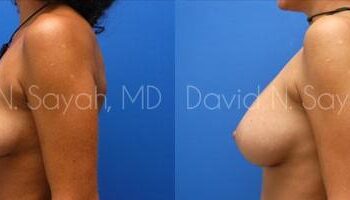 Breast Augmentation Before and After | Sayah Institute