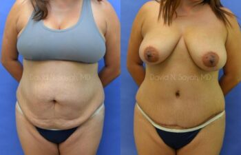 Scar Revision Body Before and After | Sayah Institute