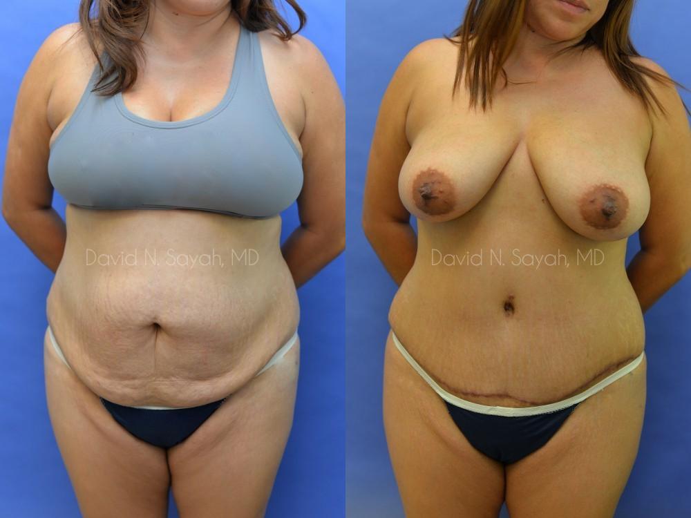 Scar Revision Body Before and After | Sayah Institute