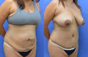 Scar Revision Body Before and After | Sayah Institute