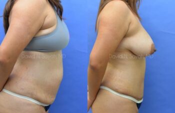 Scar Revision Body Before and After | Sayah Institute
