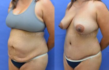 Scar Revision Body Before and After | Sayah Institute