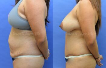 Scar Revision Body Before and After | Sayah Institute