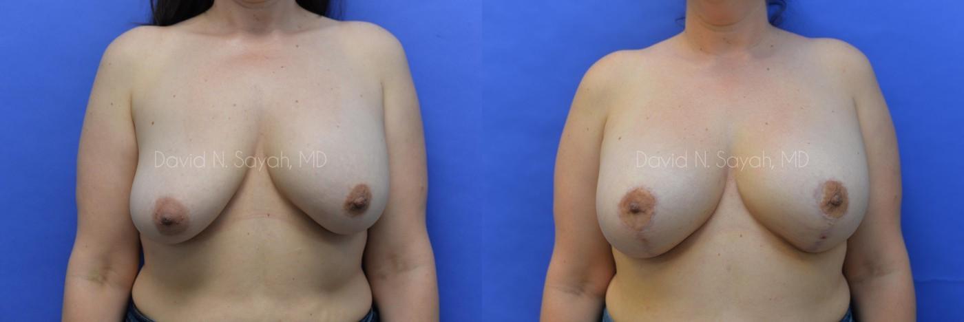 Breast Augmentation And Mastopexy Before and After | Sayah Institute