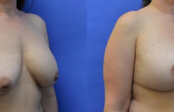 Breast Augmentation And Mastopexy Before and After | Sayah Institute