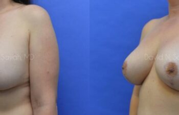 Breast Augmentation And Mastopexy Before and After | Sayah Institute