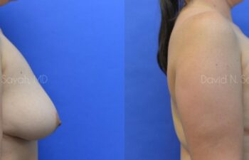 Breast Augmentation And Mastopexy Before and After | Sayah Institute