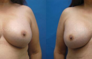 Breast Augmentation Before and After | Sayah Institute
