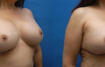Breast Augmentation Before and After | Sayah Institute