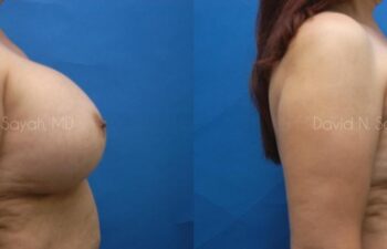 Breast Augmentation Before and After | Sayah Institute